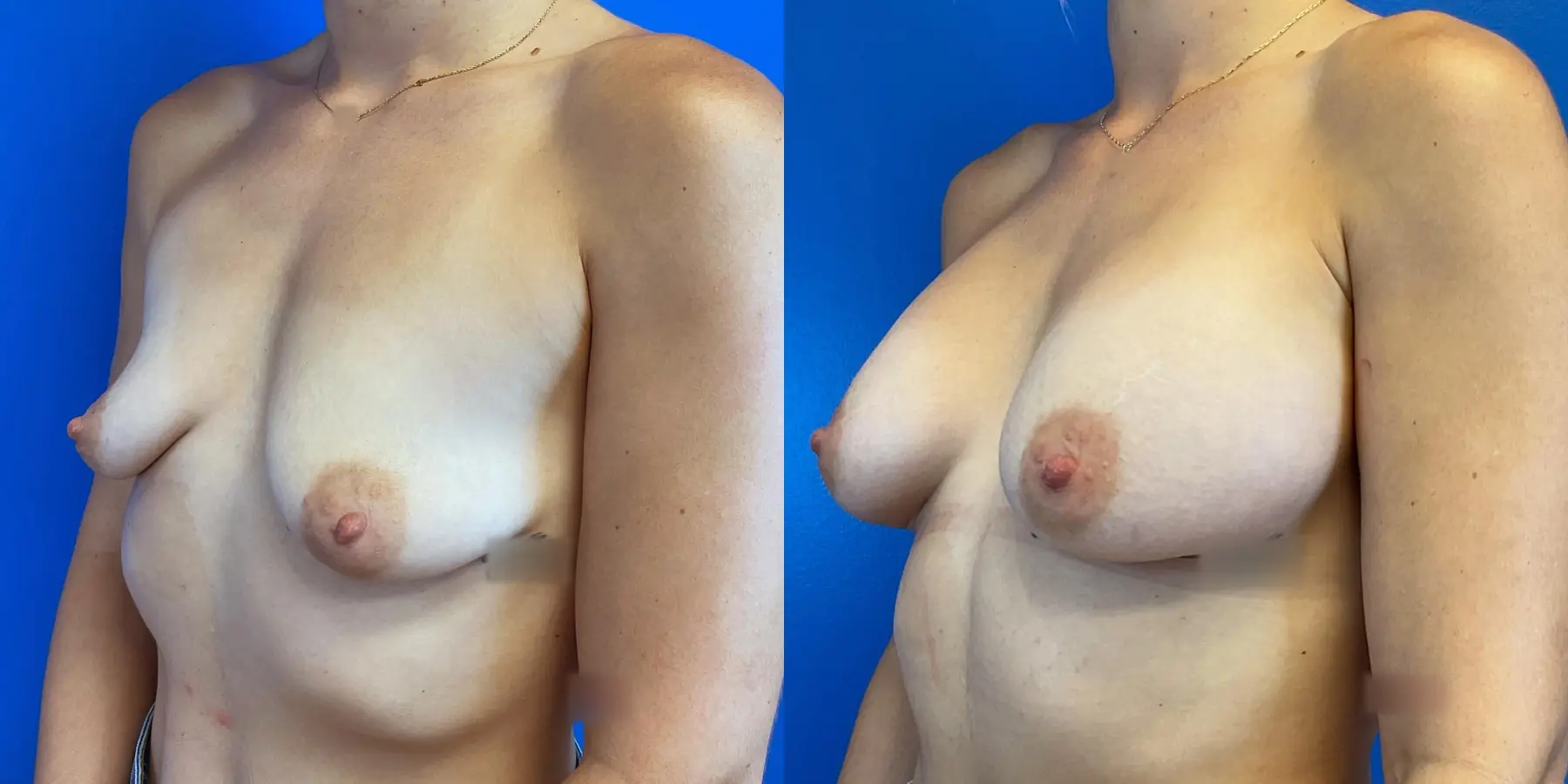 Breast Augmentation: Patient 1 - Before and After 2