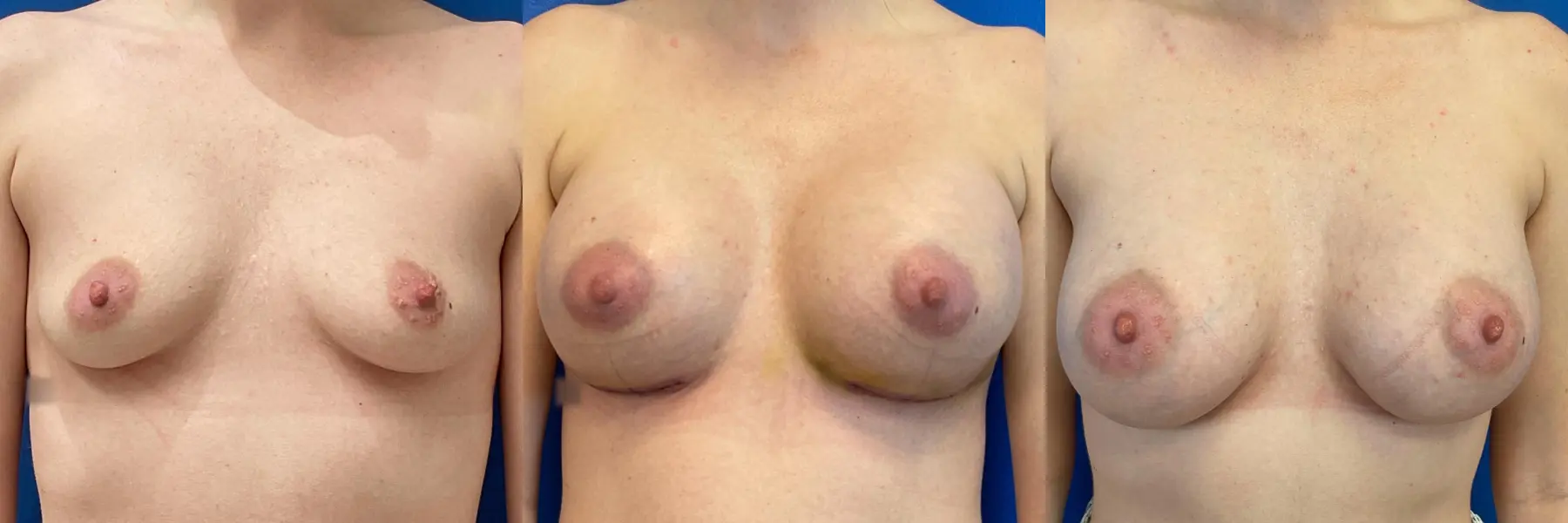 Breast Augmentation: Patient 1 - Before and After 1