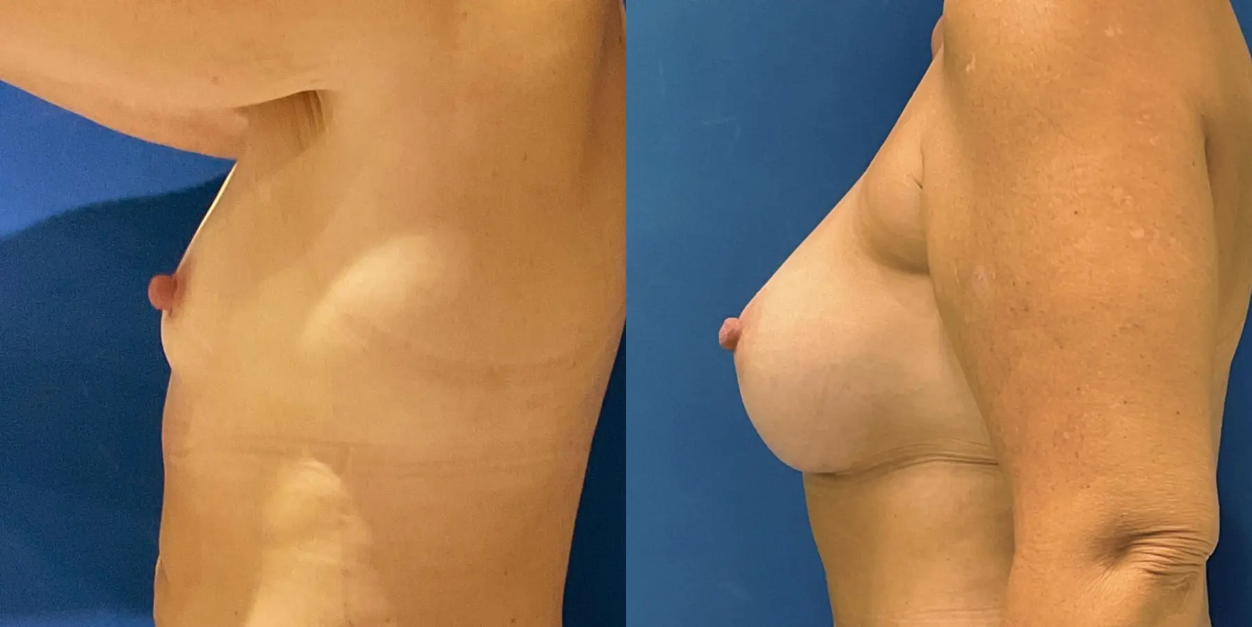 Breast Augmentation: Patient 6 - Before and After 4