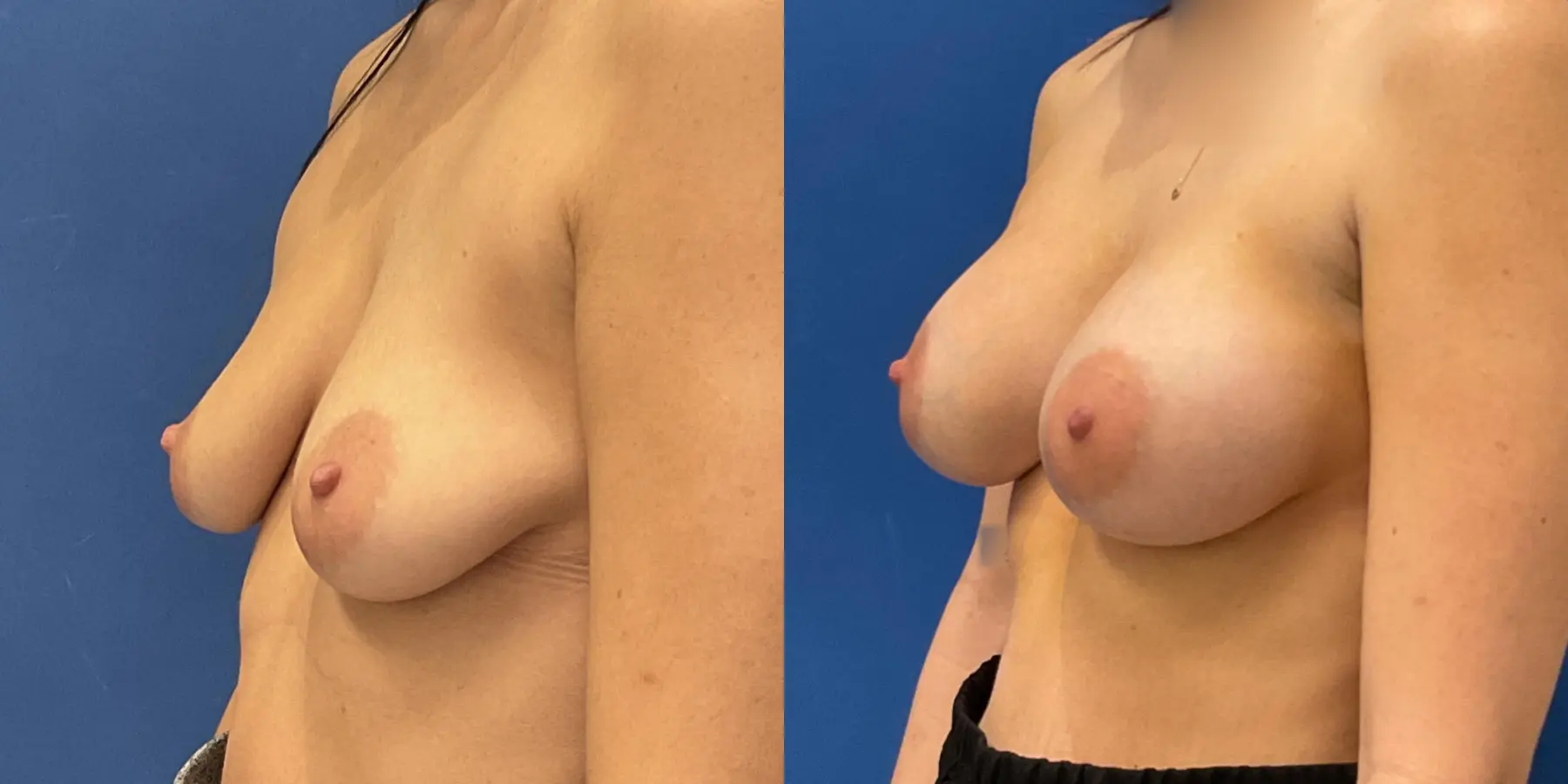 Breast Augmentation: Patient 3 - Before and After 2