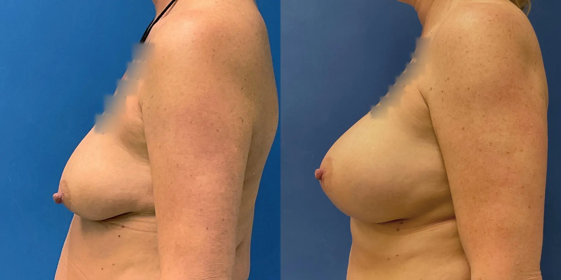 Breast Augmentation: Patient 16 - Before and After 4