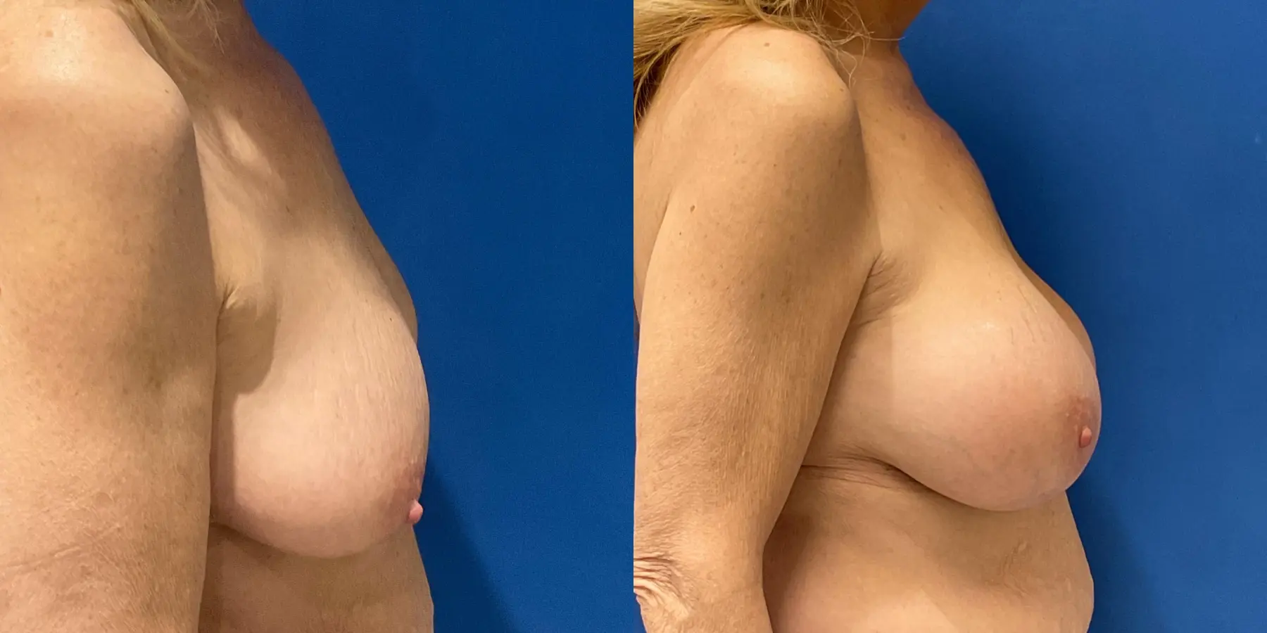 Breast Augmentation: Patient 9 - Before and After 5