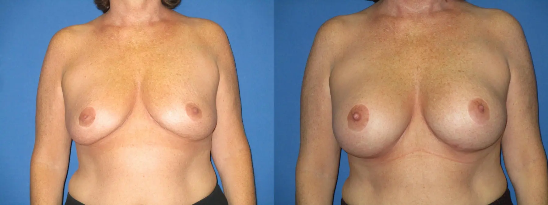 Breast Augmentation: Patient 22 - Before and After 1