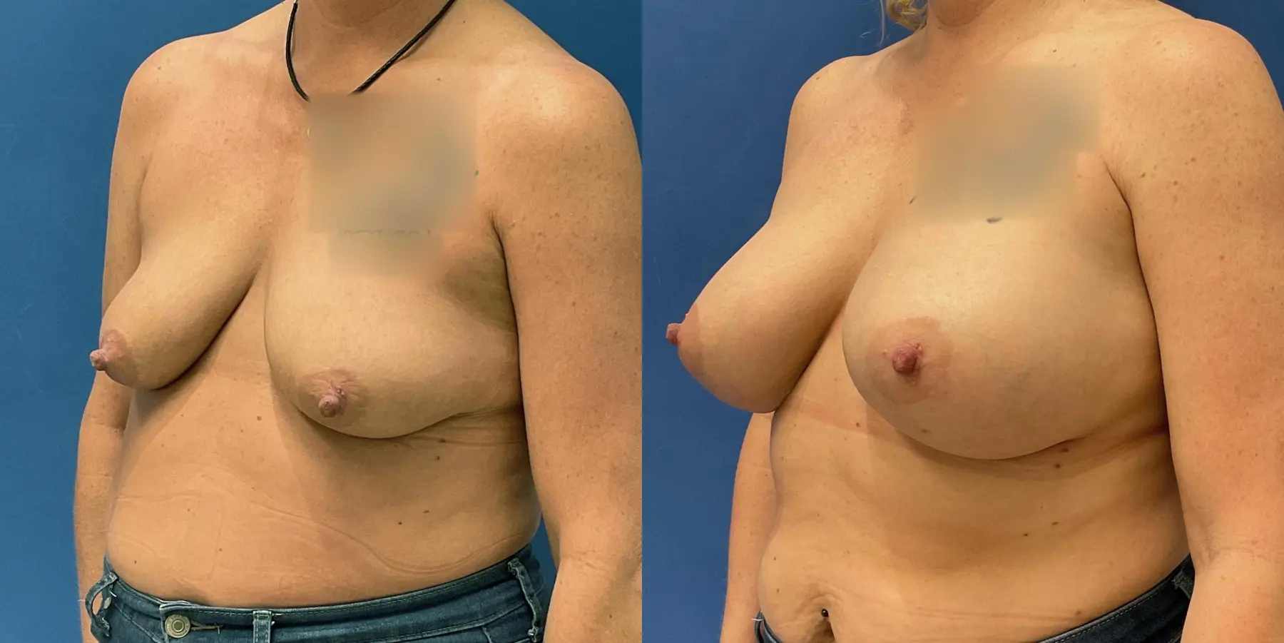 Breast Augmentation: Patient 5 - Before and After 2