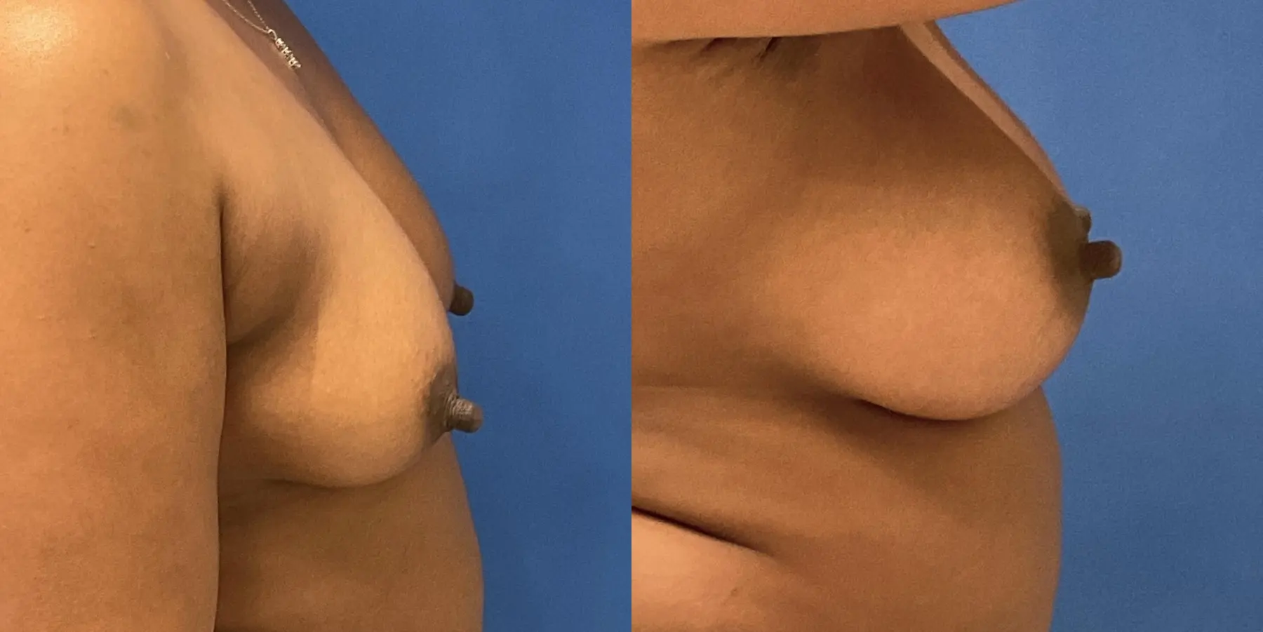 Breast Augmentation: Patient 4 - Before and After 5