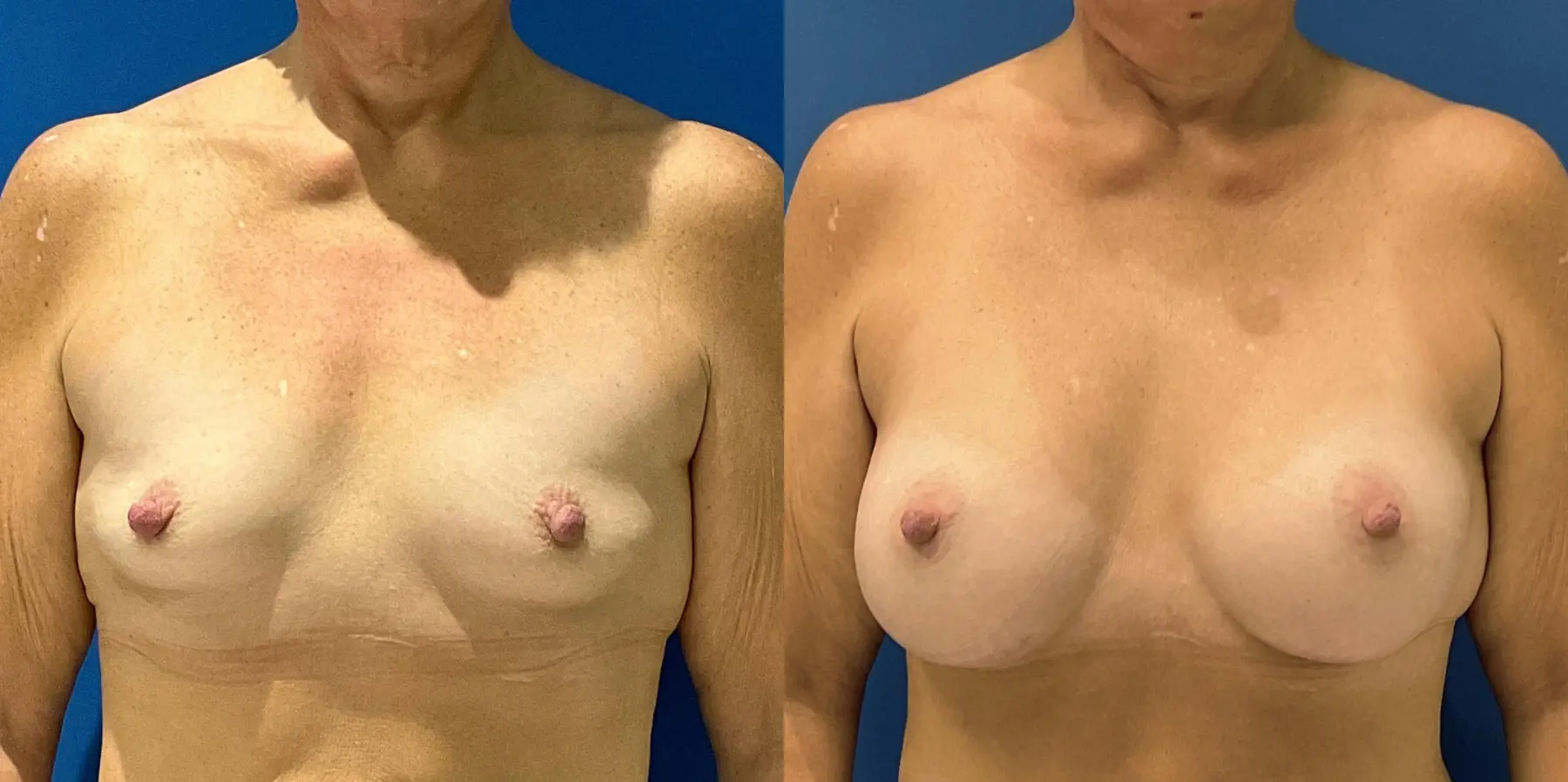 Breast Augmentation: Patient 6 - Before and After  