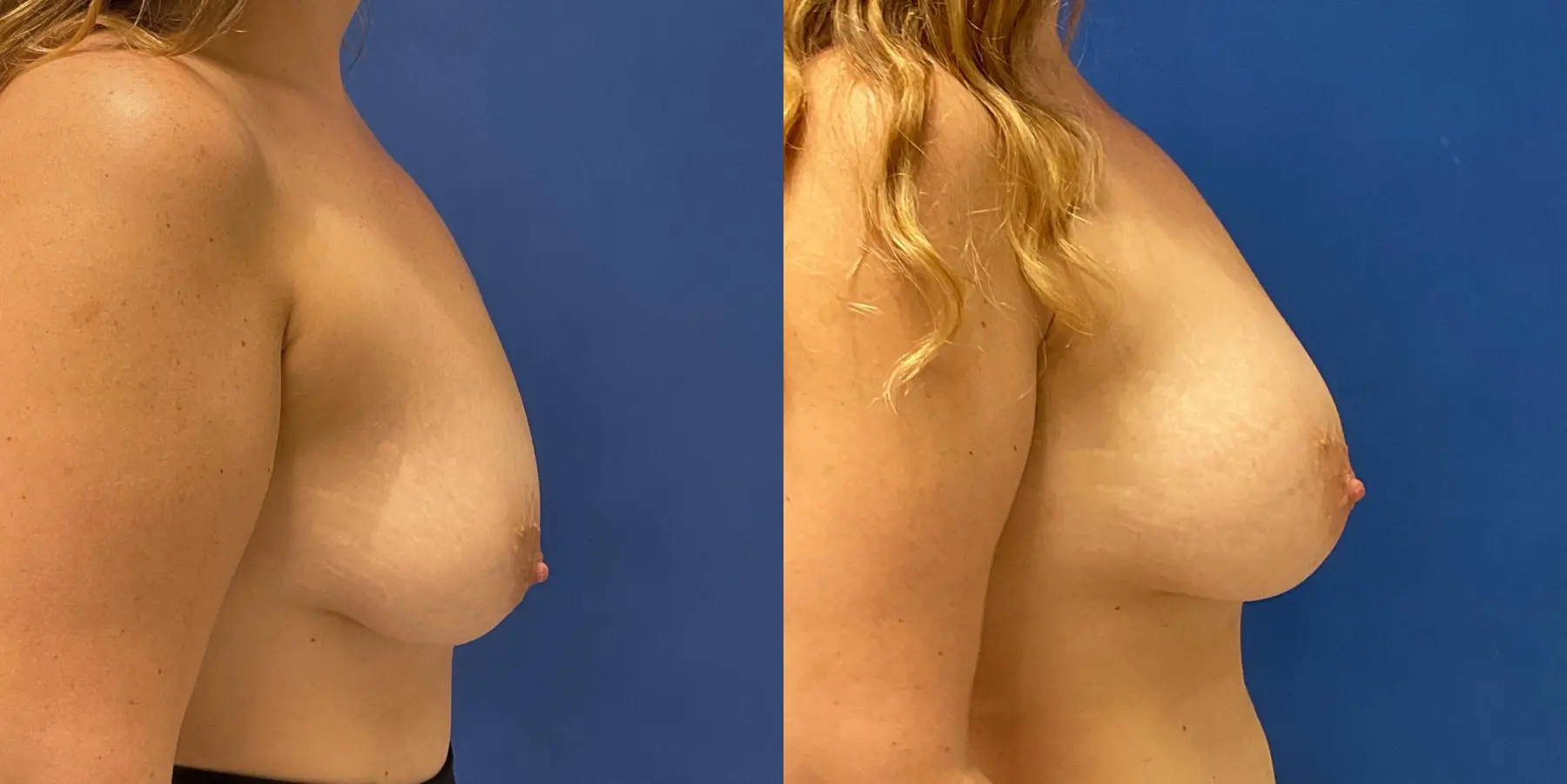 Breast Augmentation: Patient 8 - Before and After 5