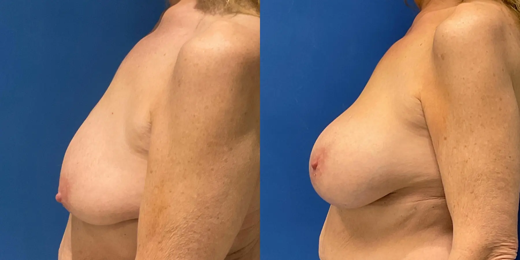 Breast Augmentation: Patient 9 - Before and After 4