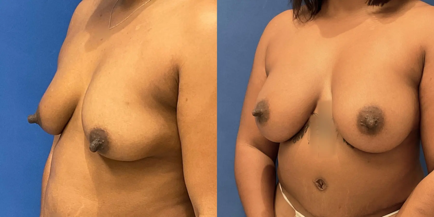 Breast Augmentation: Patient 15 - Before and After 2