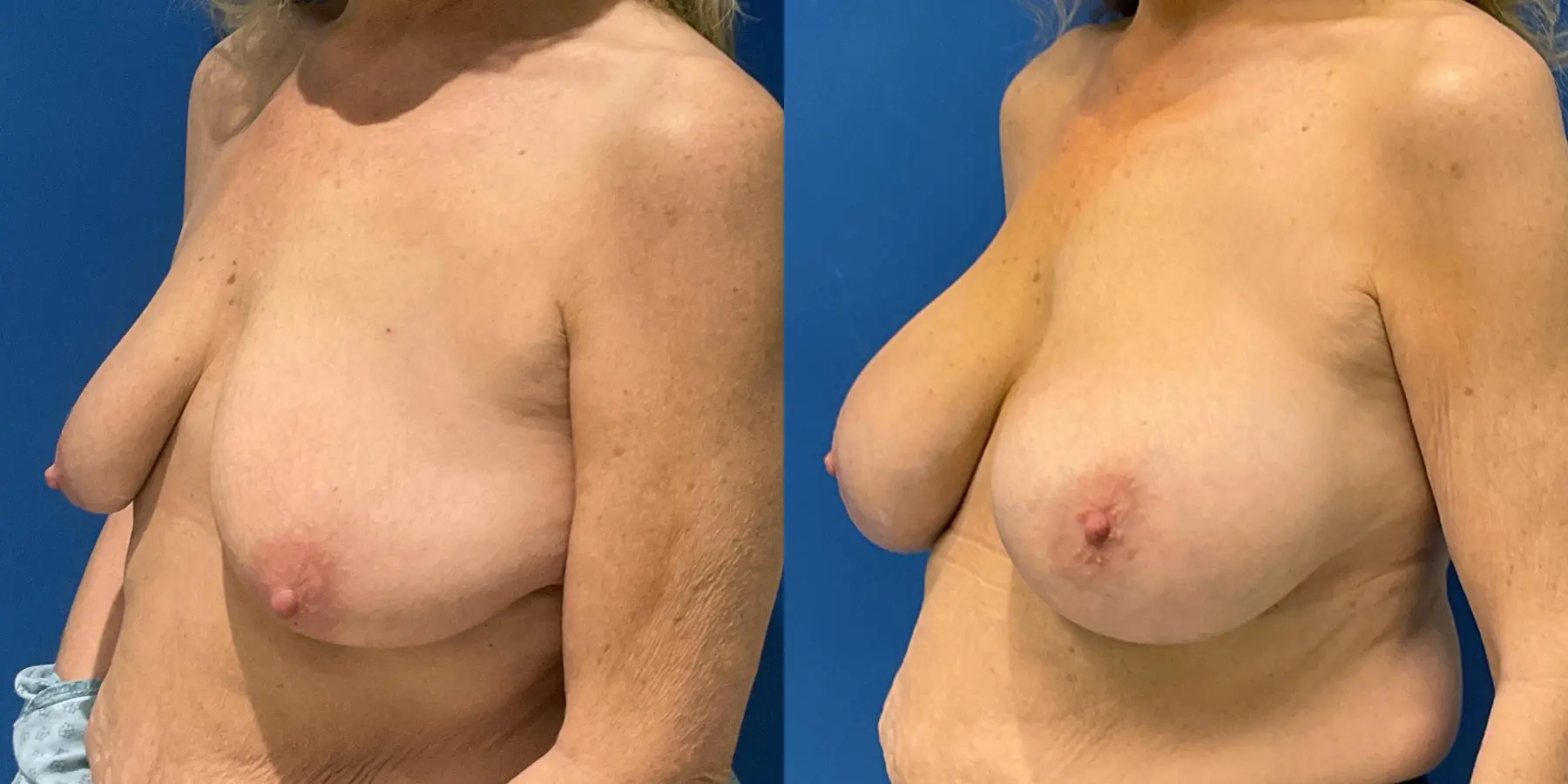 Breast Augmentation: Patient 9 - Before and After 2