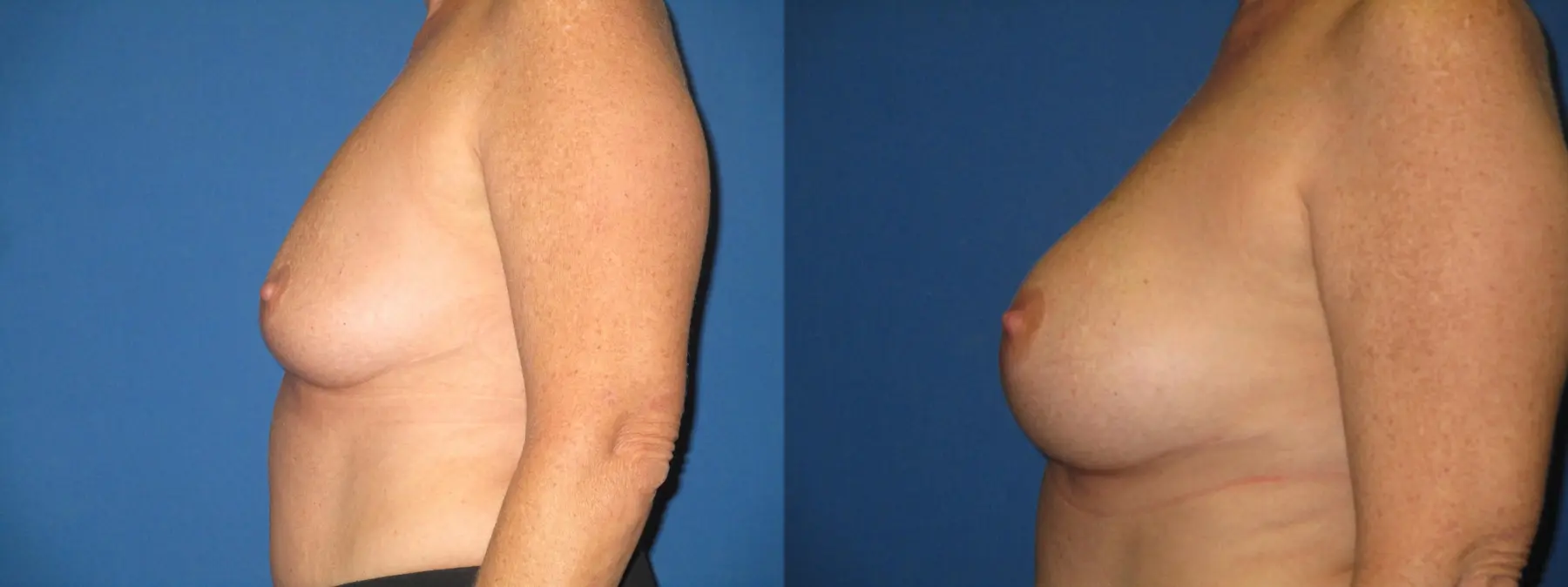 Breast Augmentation: Patient 22 - Before and After 2