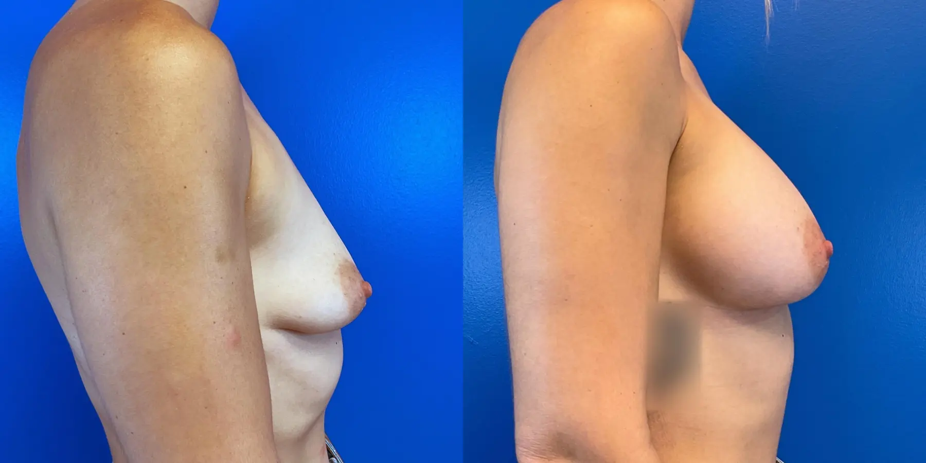 Breast Augmentation: Patient 1 - Before and After 5