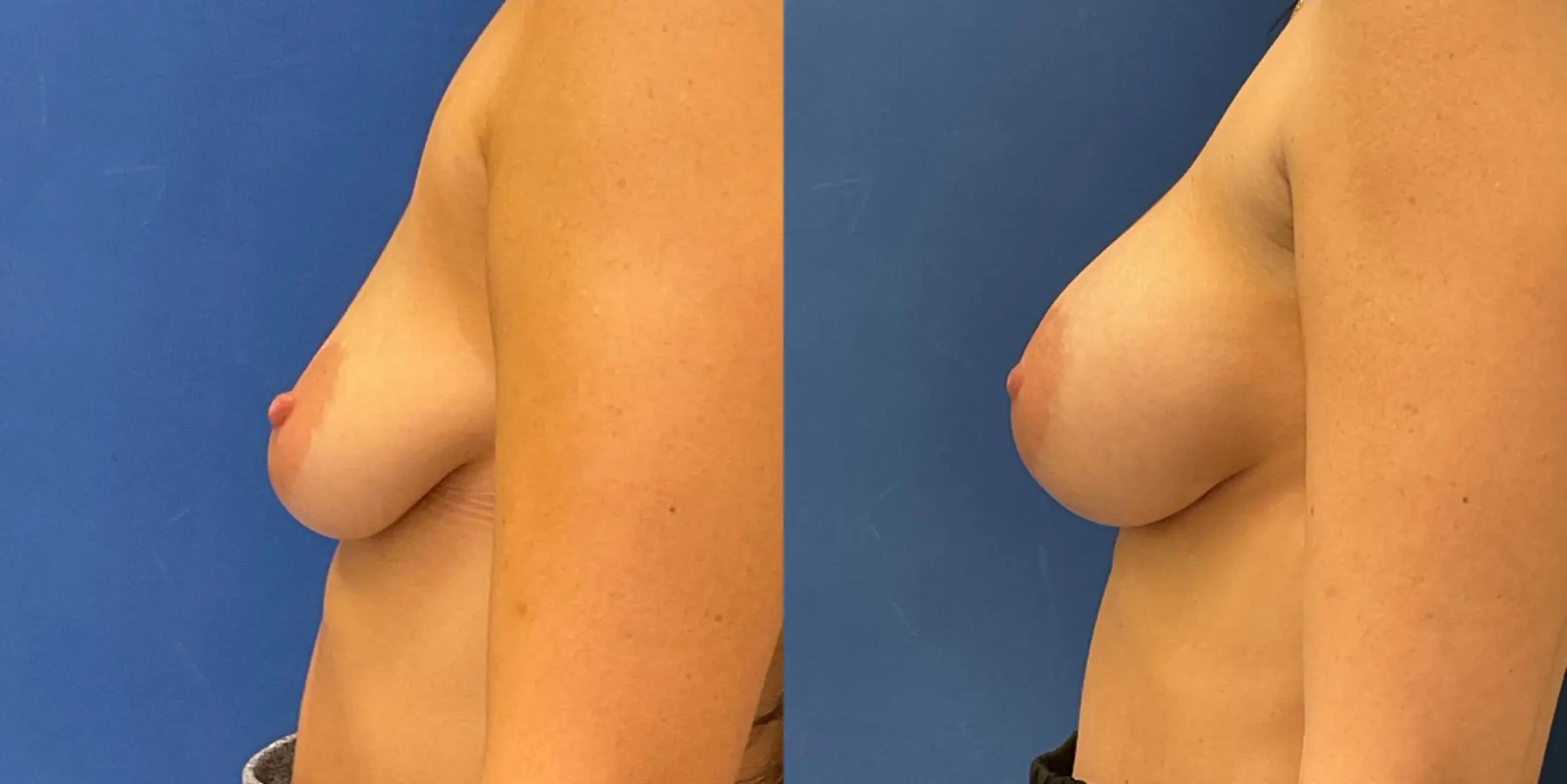 Breast Augmentation: Patient 3 - Before and After 4