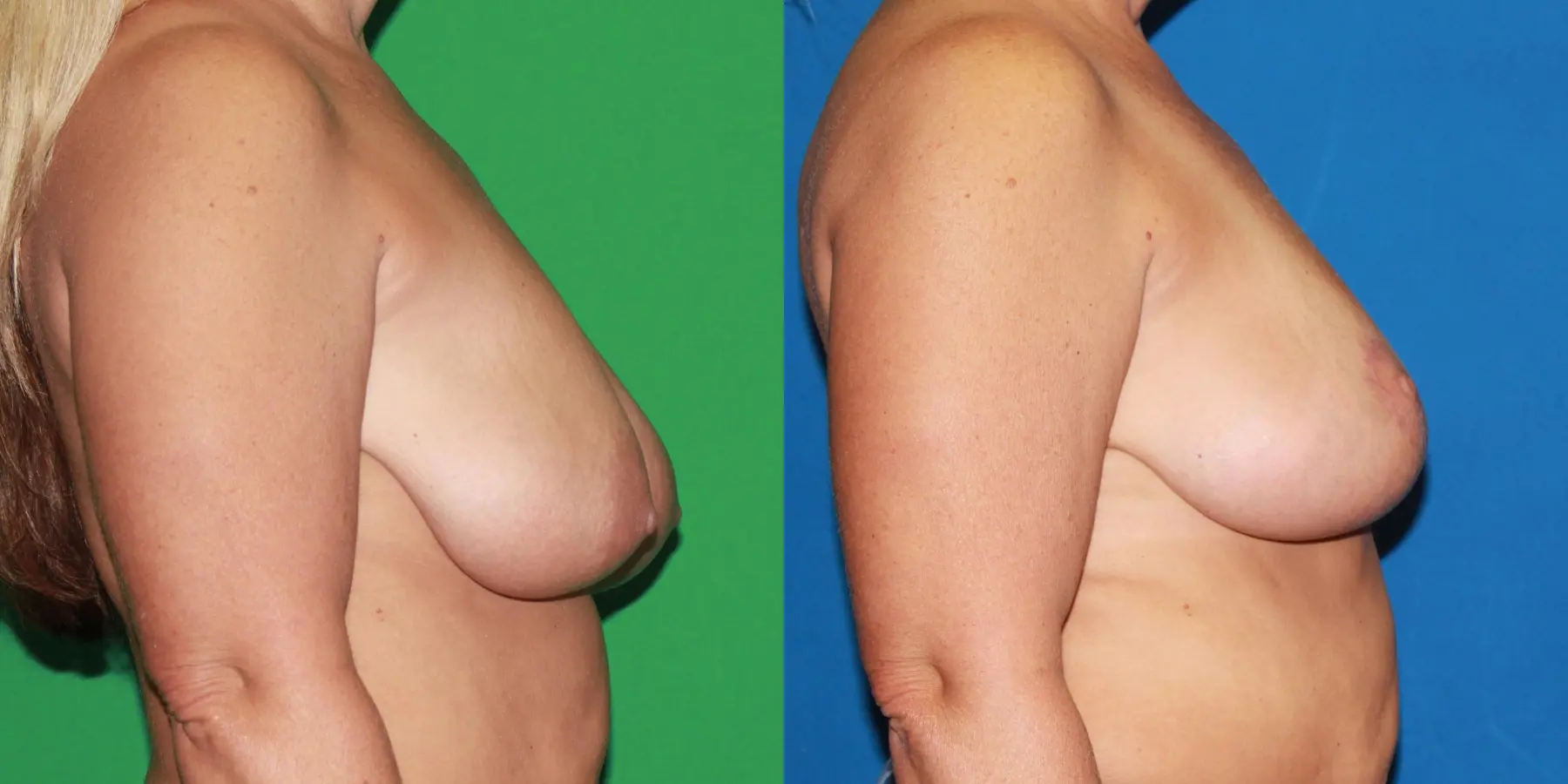 Breast Lift: Patient 3 - Before and After 2