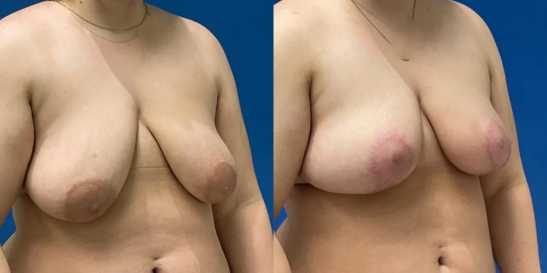 Breast Lift: Patient 5 - Before and After 3