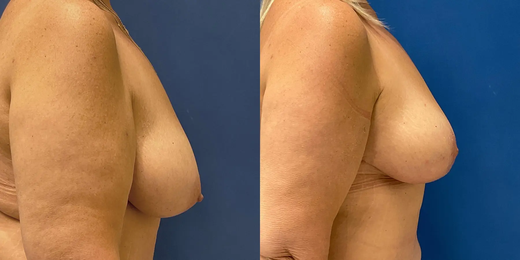 Breast Lift: Patient 2 - Before and After 5