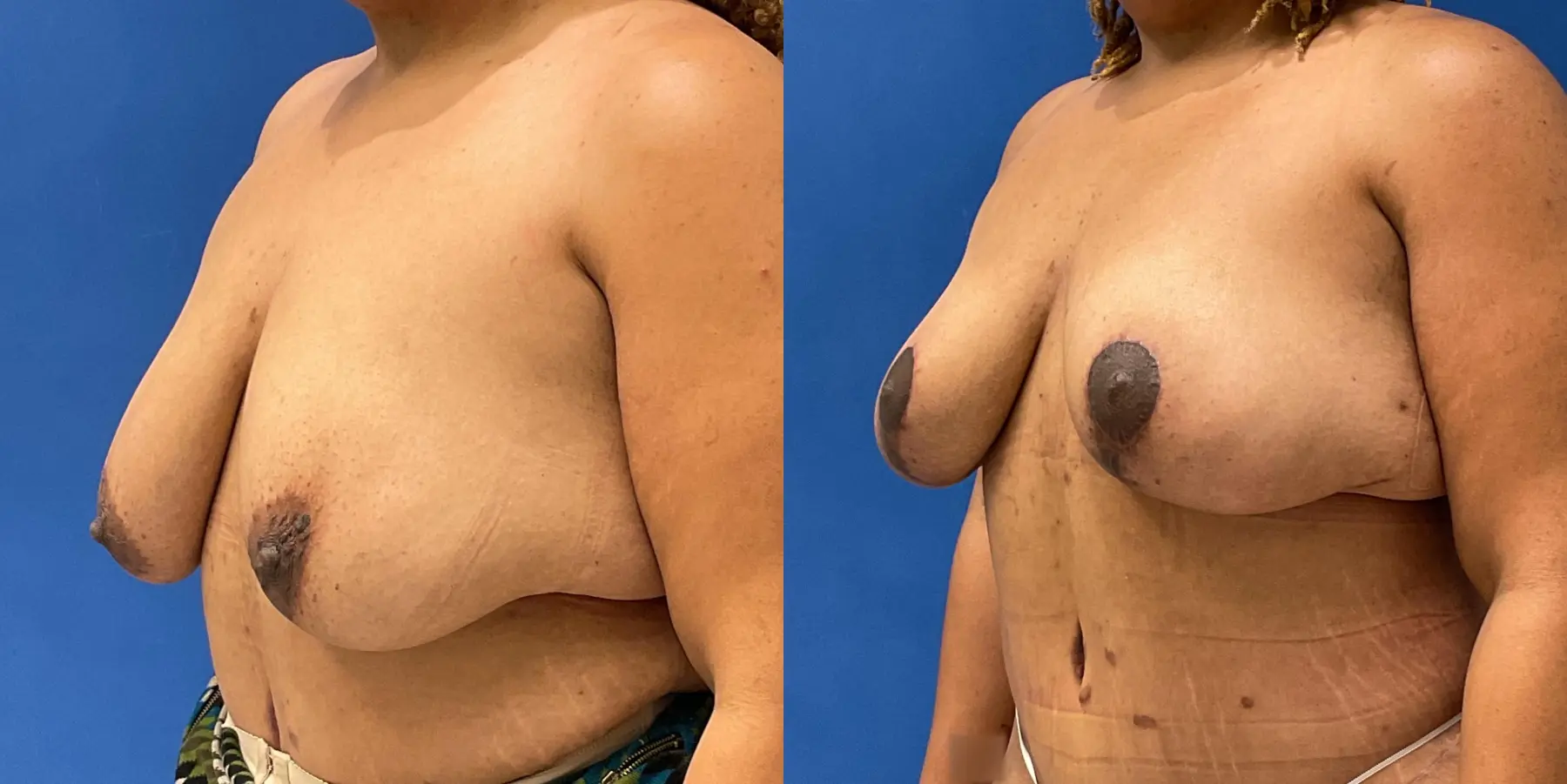 Breast Lift: Patient 6 - Before and After 2