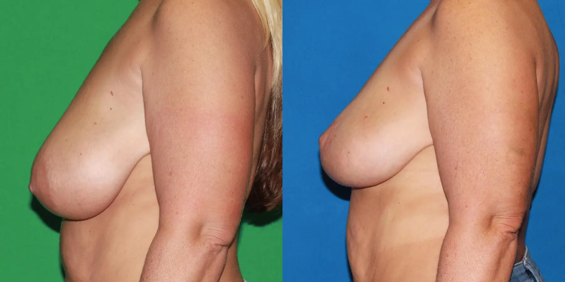 Breast Lift: Patient 3 - Before and After 3