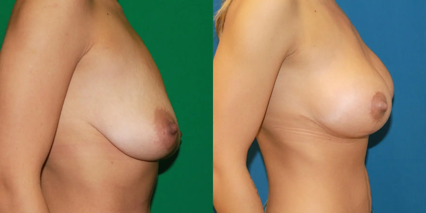 Breast Lift: Patient 7 - Before and After 2