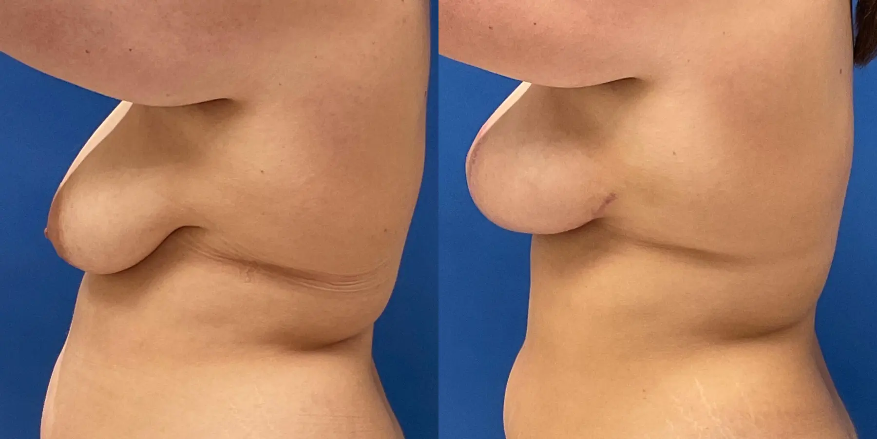 Breast Lift: Patient 5 - Before and After 4