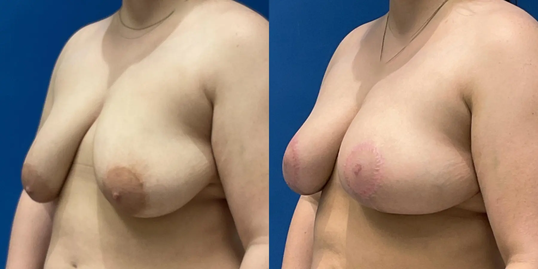 Breast Lift: Patient 5 - Before and After 2