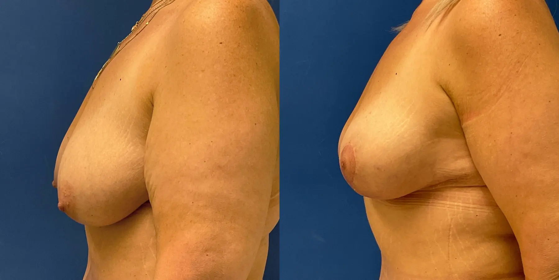 Breast Lift: Patient 2 - Before and After 4