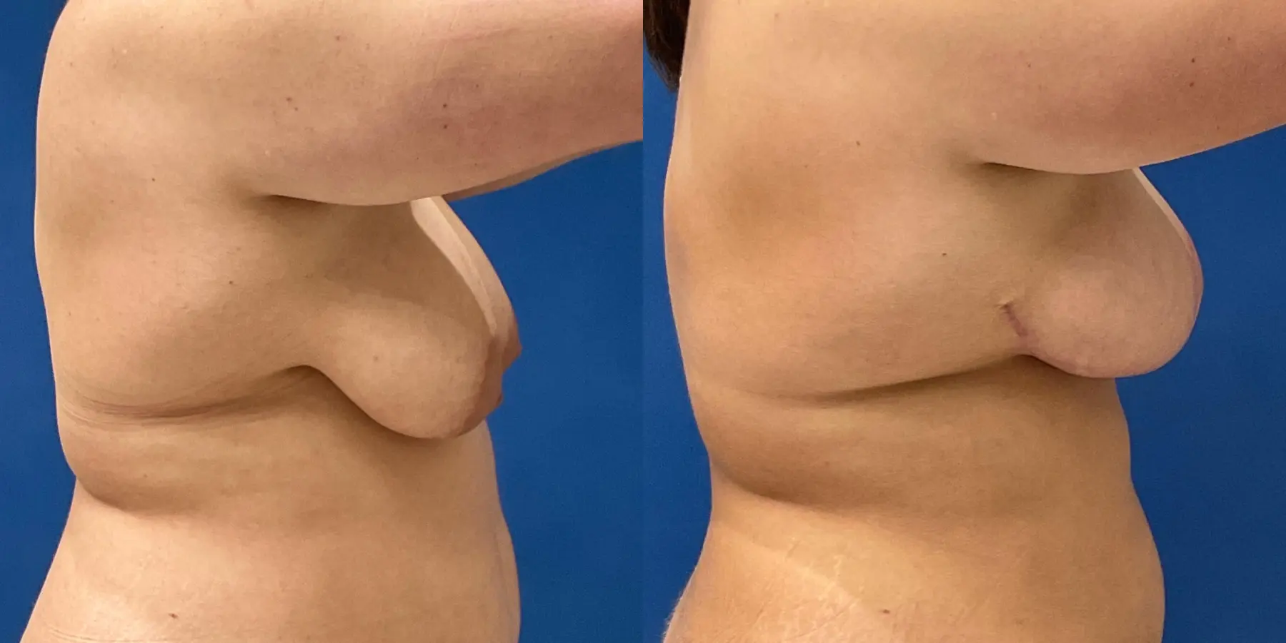 Breast Lift: Patient 5 - Before and After 5