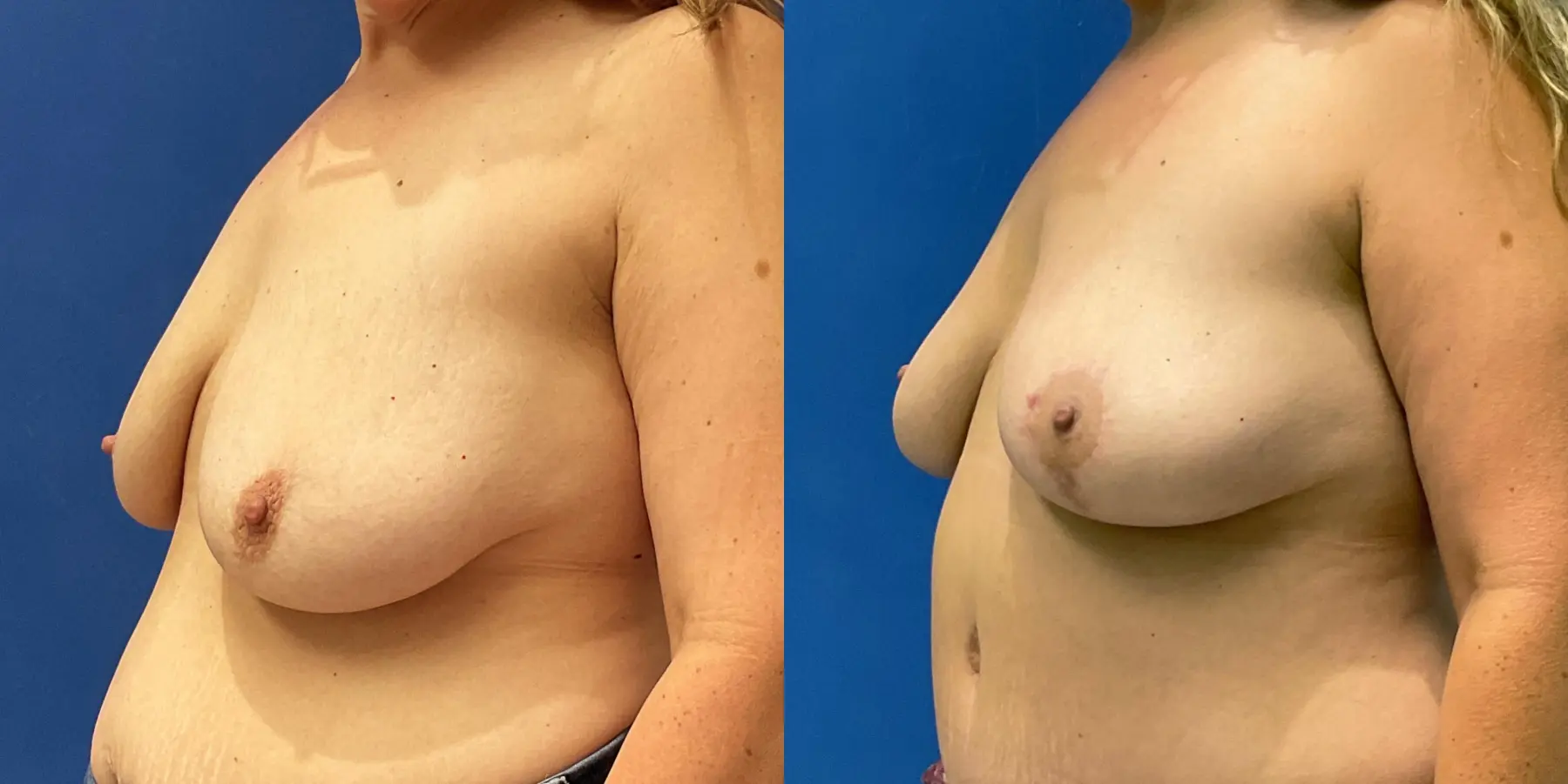 Breast Lift: Patient 4 - Before and After 2