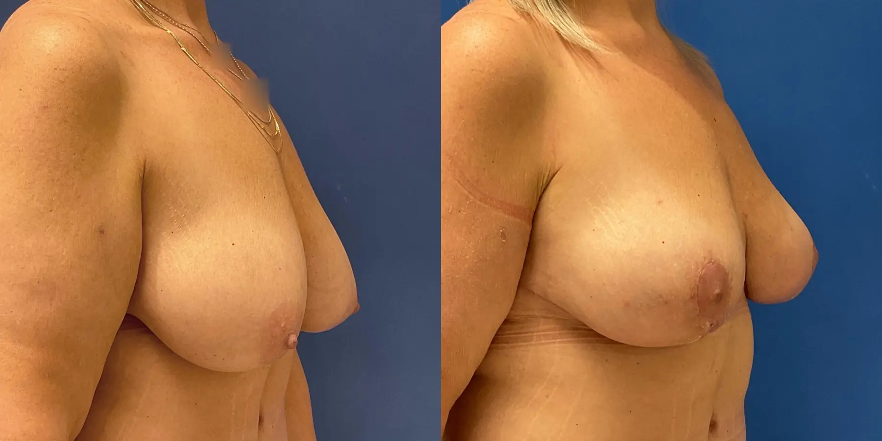 Breast Lift: Patient 2 - Before and After 3