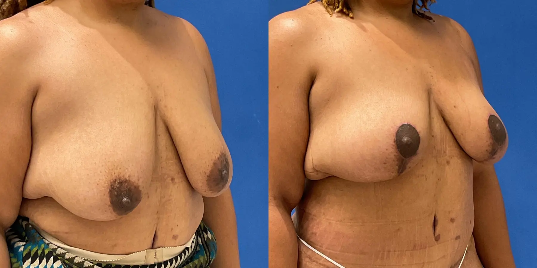 Breast Lift: Patient 6 - Before and After 3