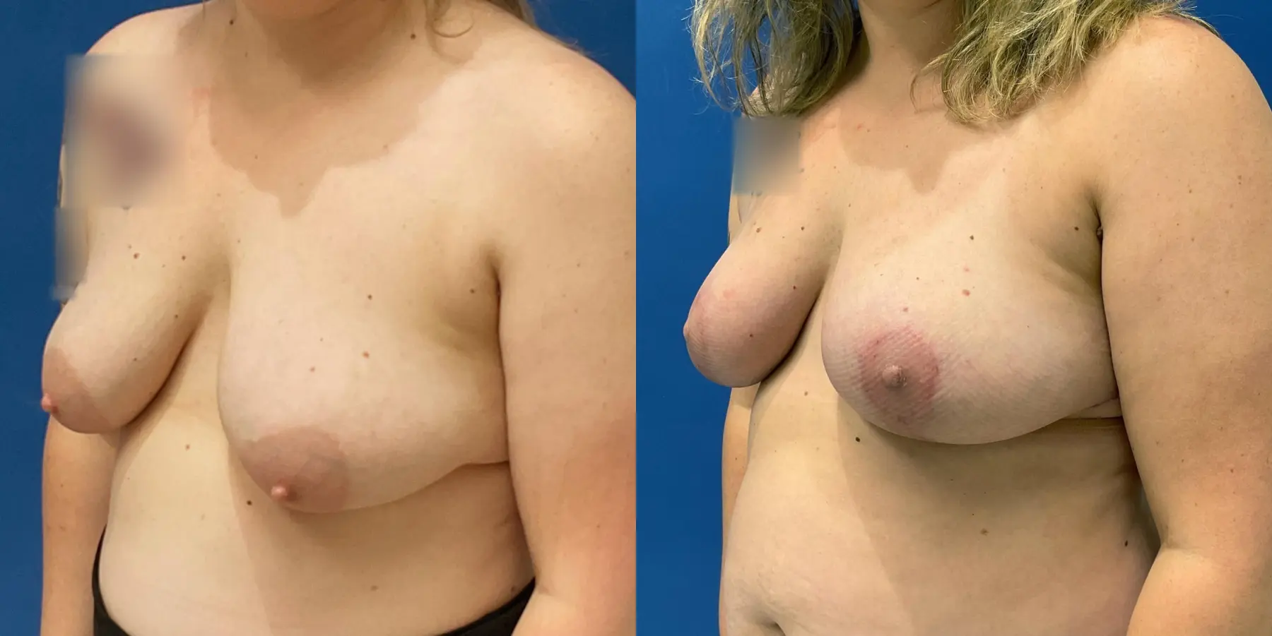 Breast Lift: Patient 1 - Before and After 2