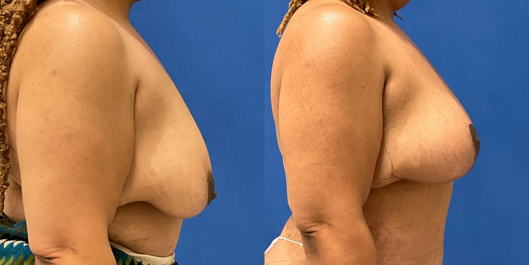 Breast Lift: Patient 6 - Before and After 5