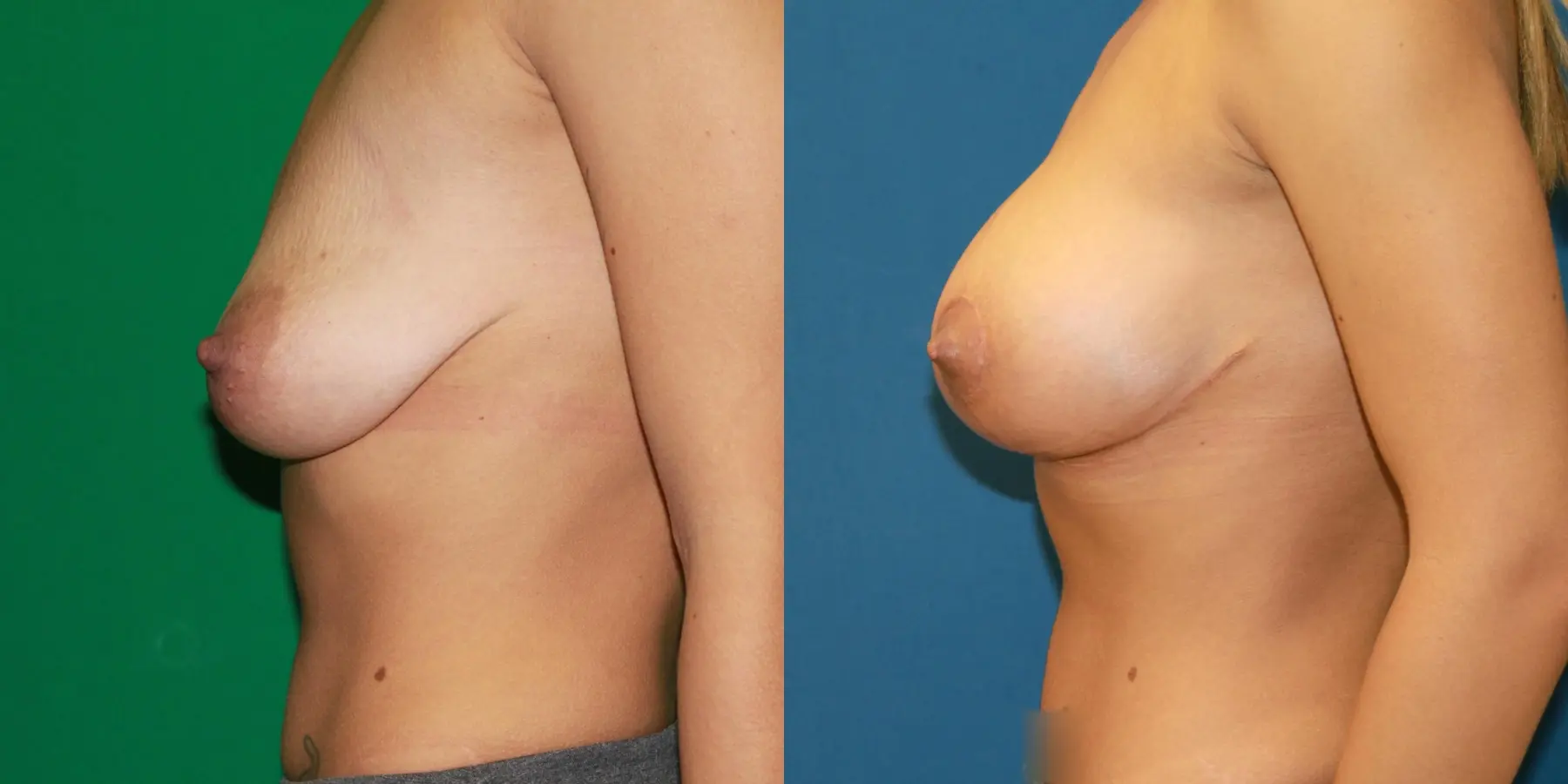 Breast Lift: Patient 7 - Before and After 3