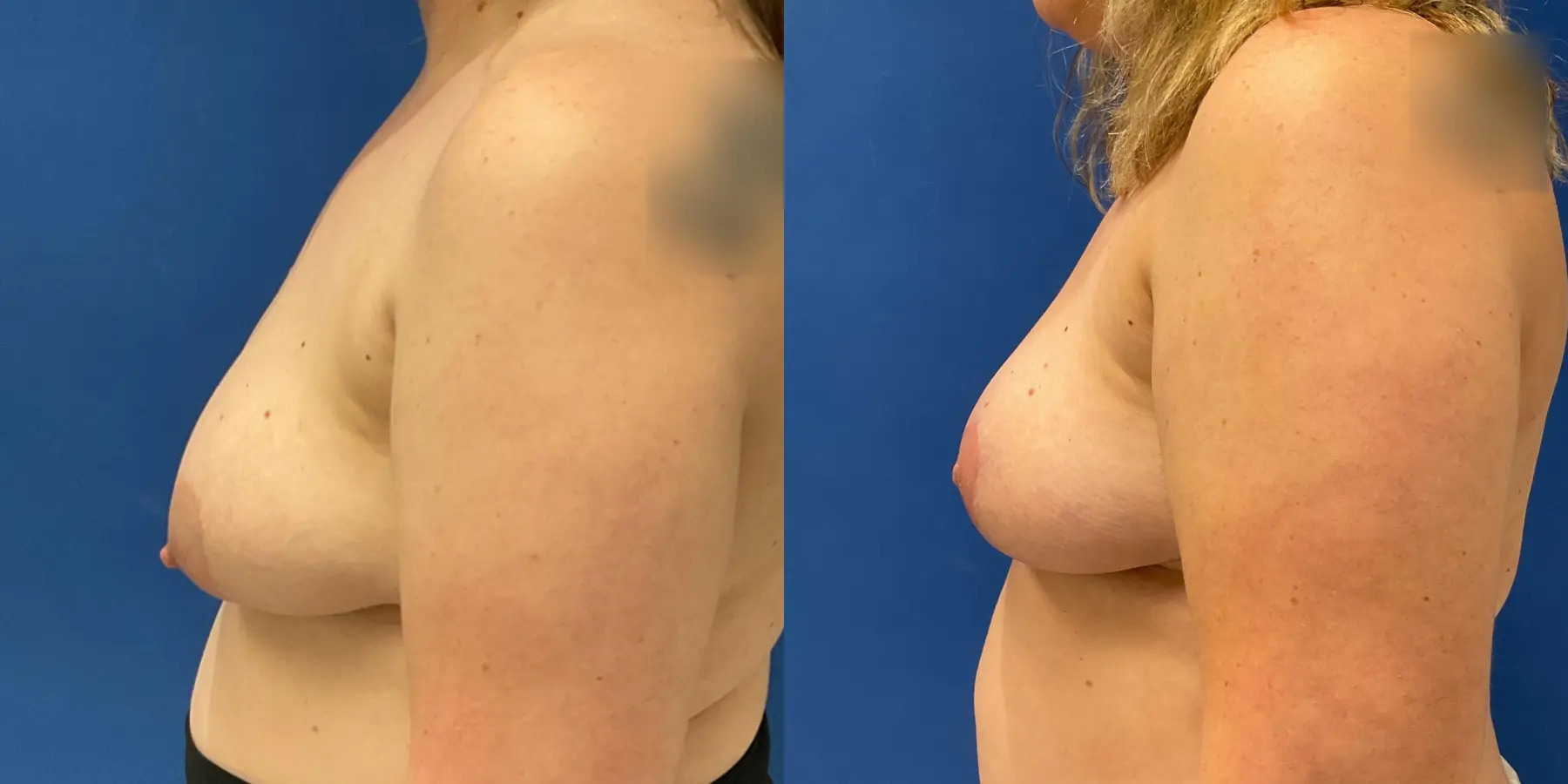 Breast Lift: Patient 1 - Before and After 4