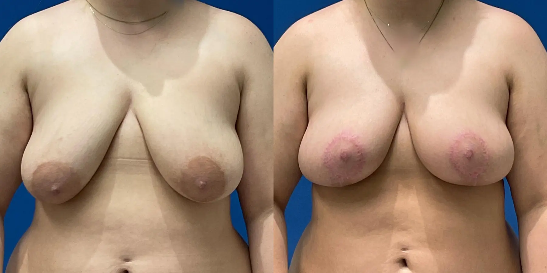 Breast Lift: Patient 5 - Before and After  