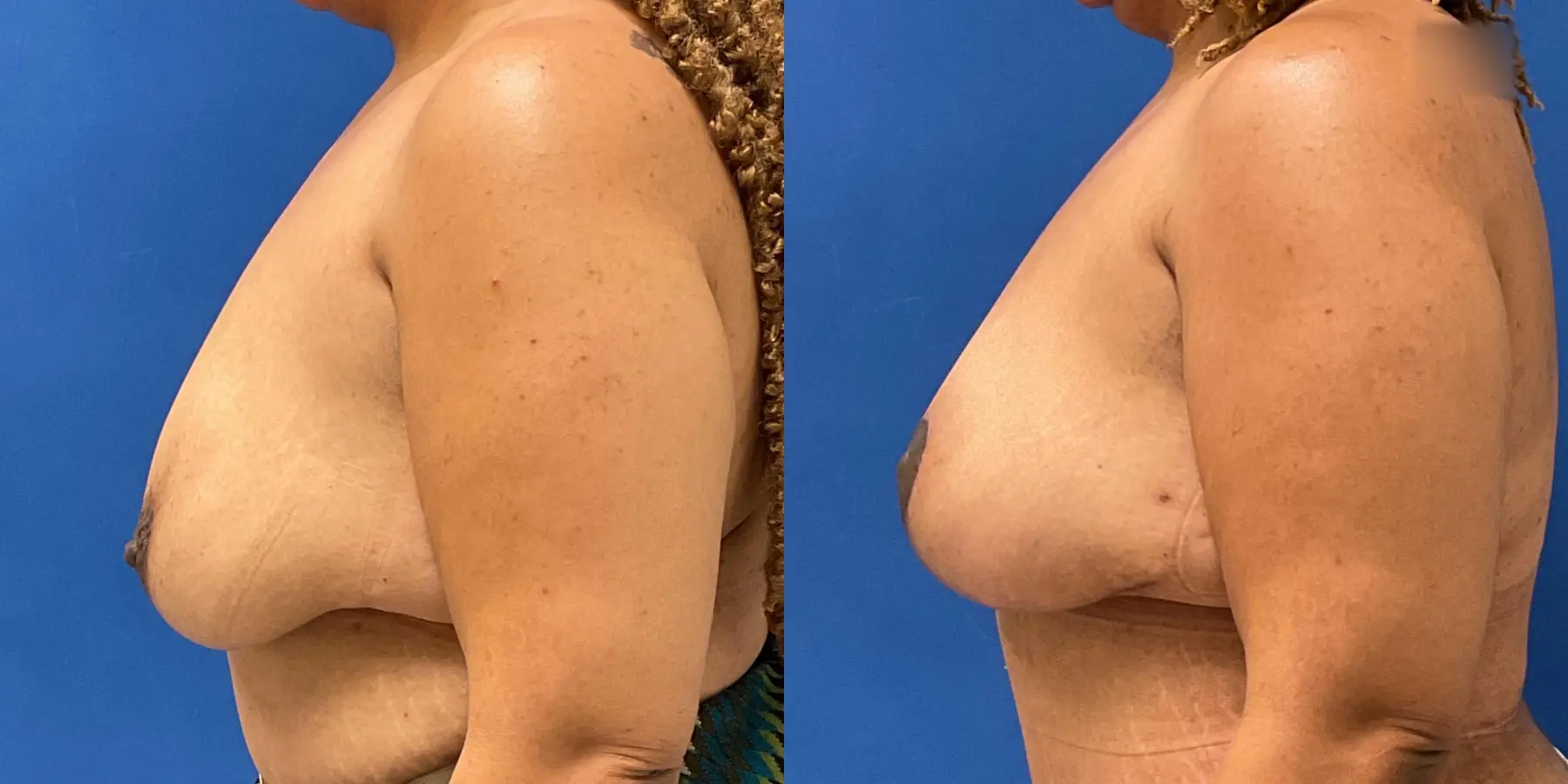 Breast Lift: Patient 6 - Before and After 4