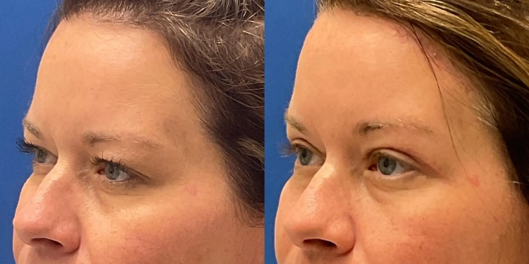 Before and after images of a brow lift. - Before and After 2