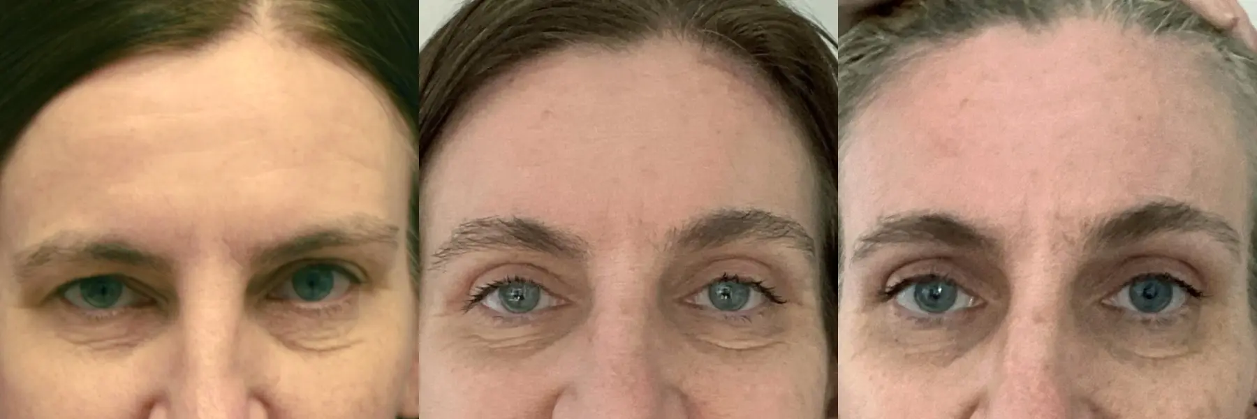 Before and after images of a brow lift. - Before and After