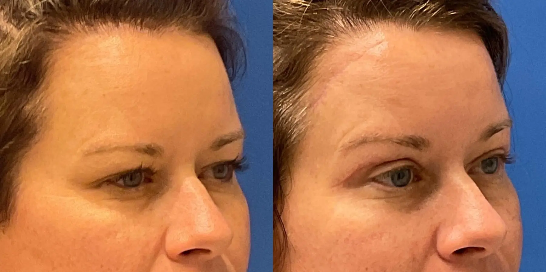 Before and after images of a brow lift. - Before and After 3