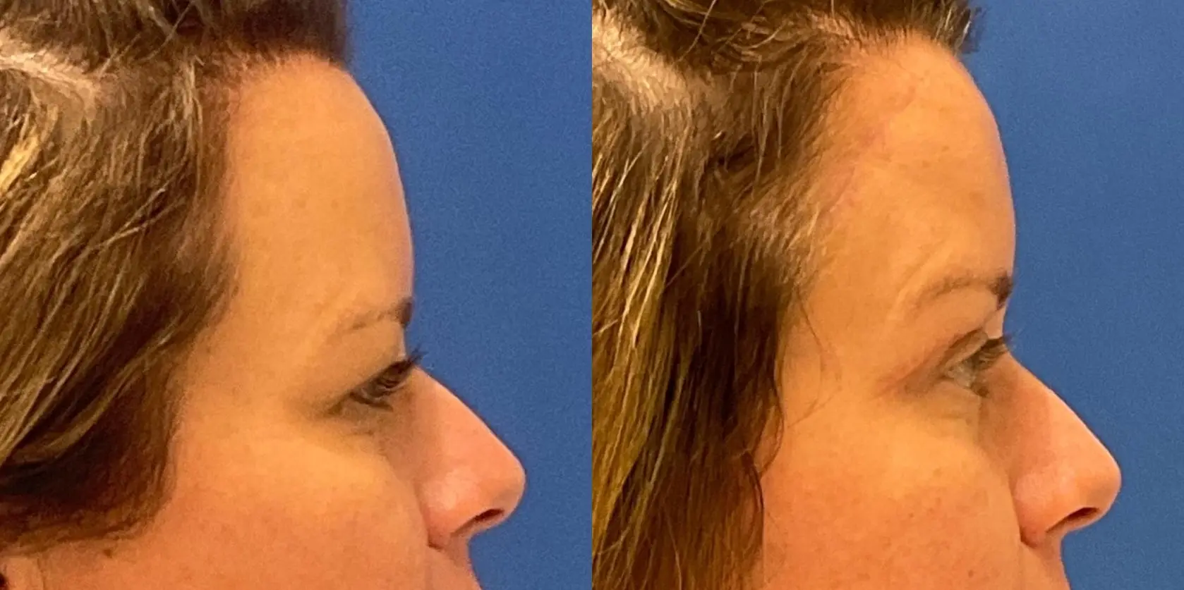 Before and after images of a brow lift. - Before and After 5