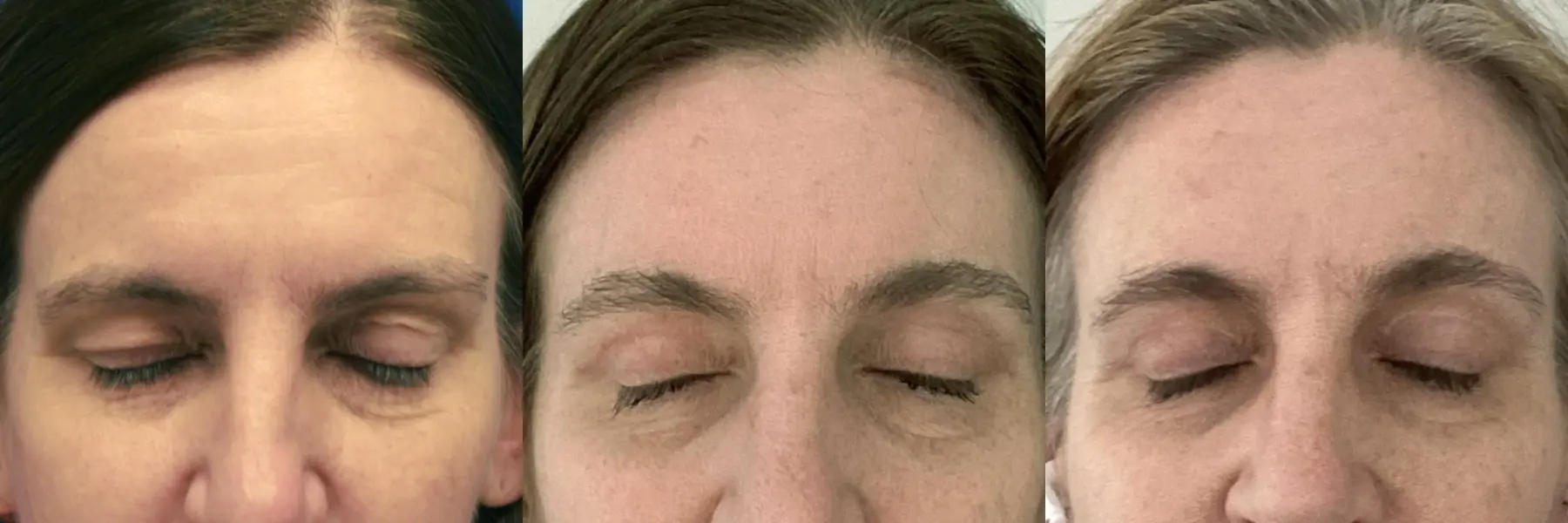 Before and after images of a brow lift. - Before and After 2