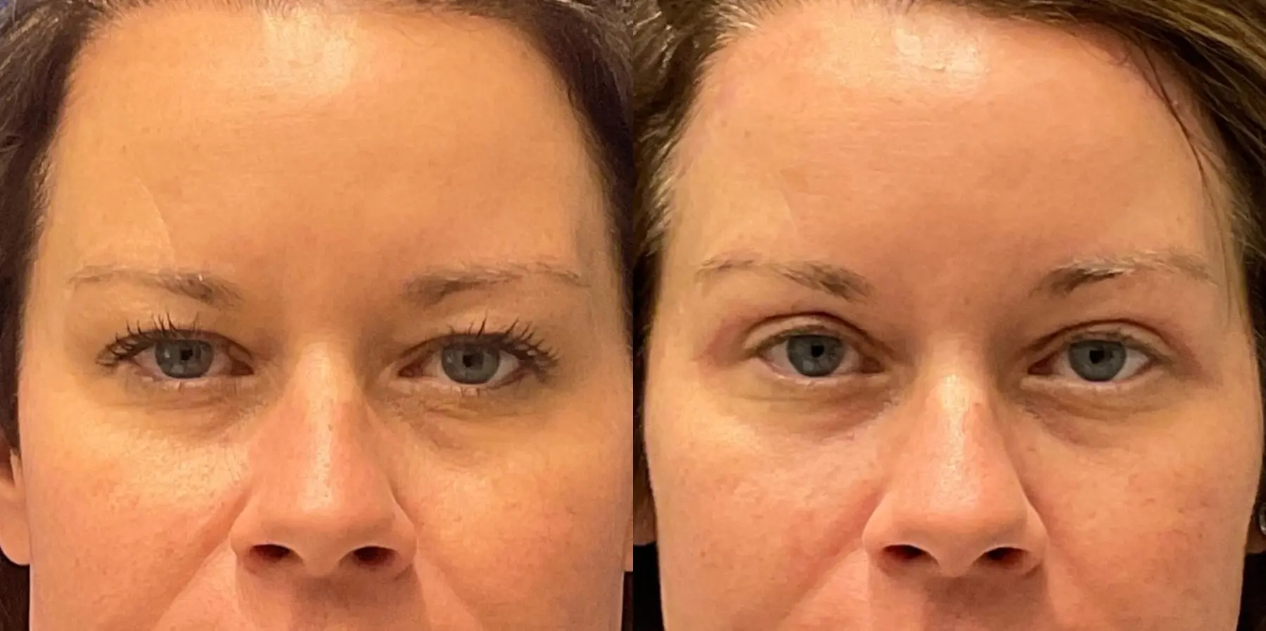 Before and after images of a brow lift. - Before and After