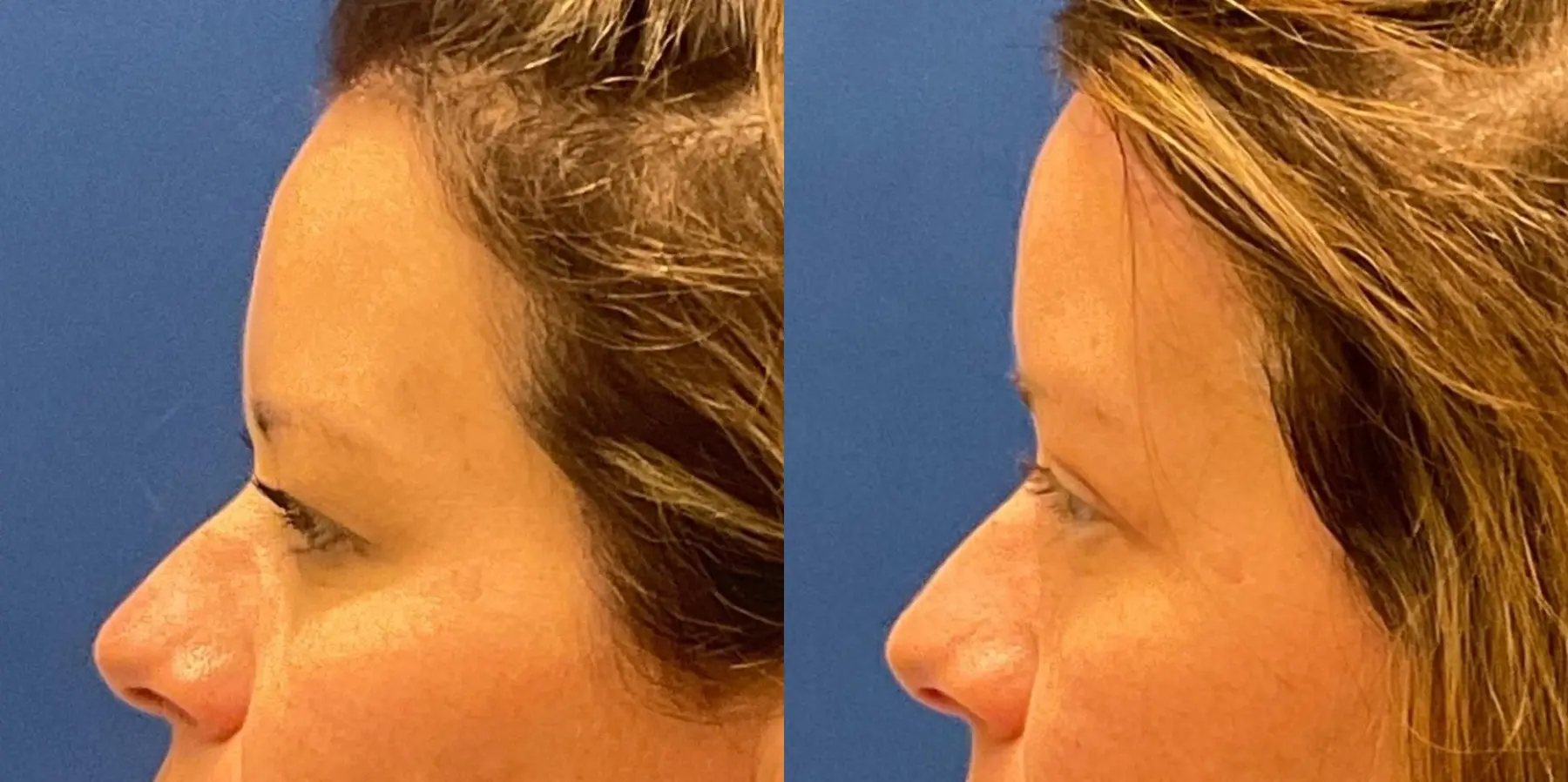 Before and after images of a brow lift. - Before and After 4