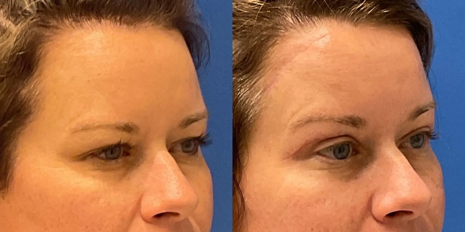 Before and after images of an eyelid surgery. - Before and After 3