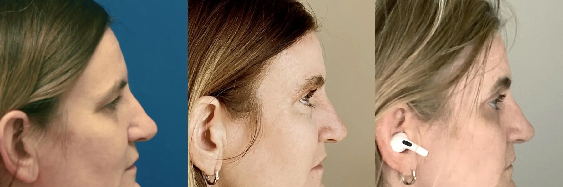 Before and after images of an eyelid surgery. - Before and After 3