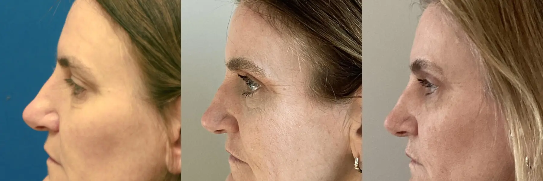 Before and after images of an eyelid surgery. - Before and After 4