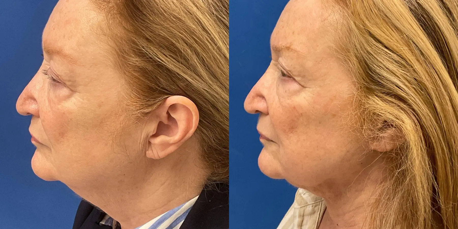 Before and after images of a Facelift. - Before and After 5