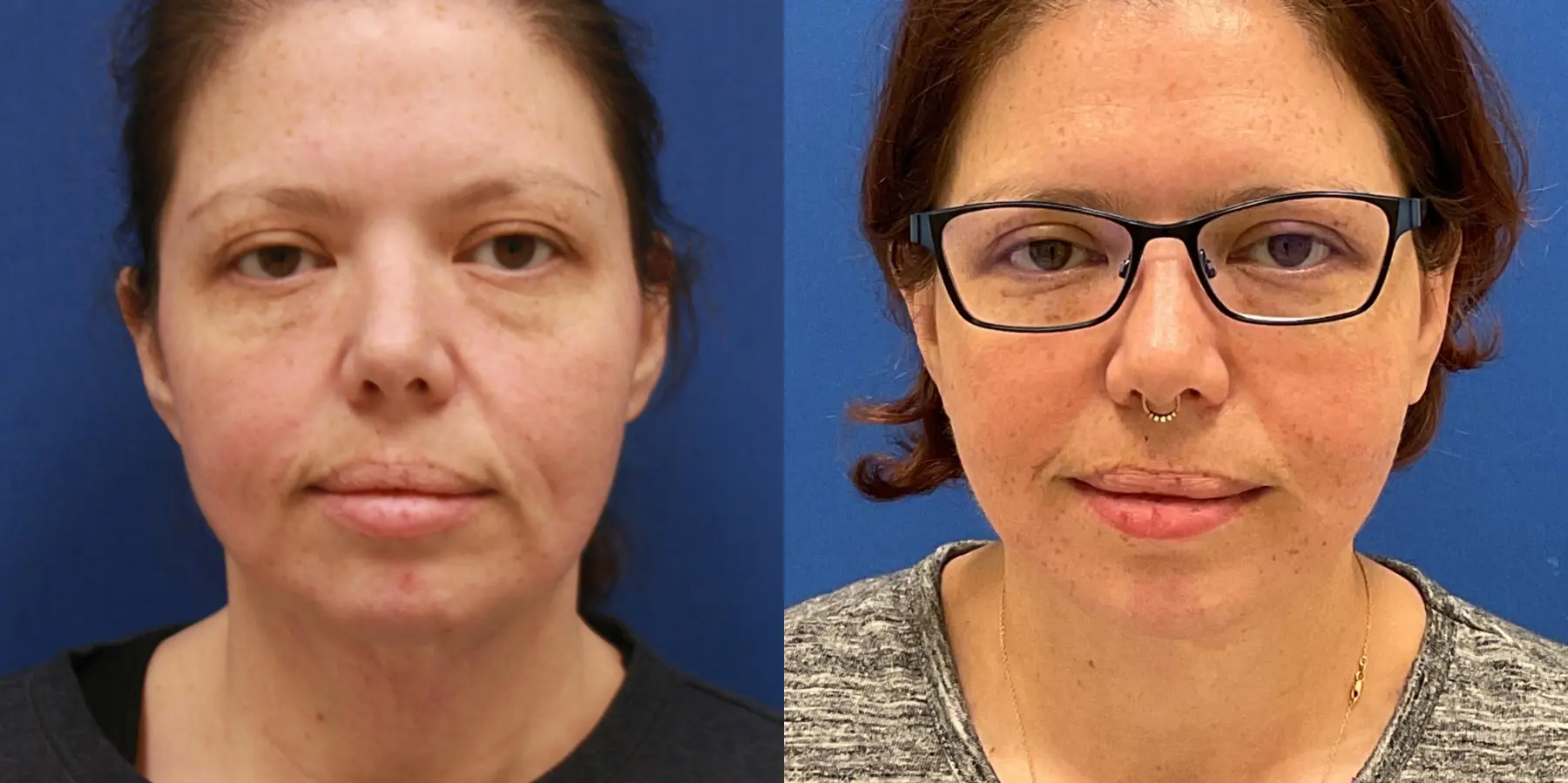 Before and after images of a Facelift. - Before and After 3