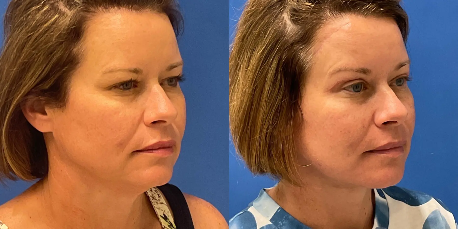 Before and after images of a Facelift. - Before and After 2