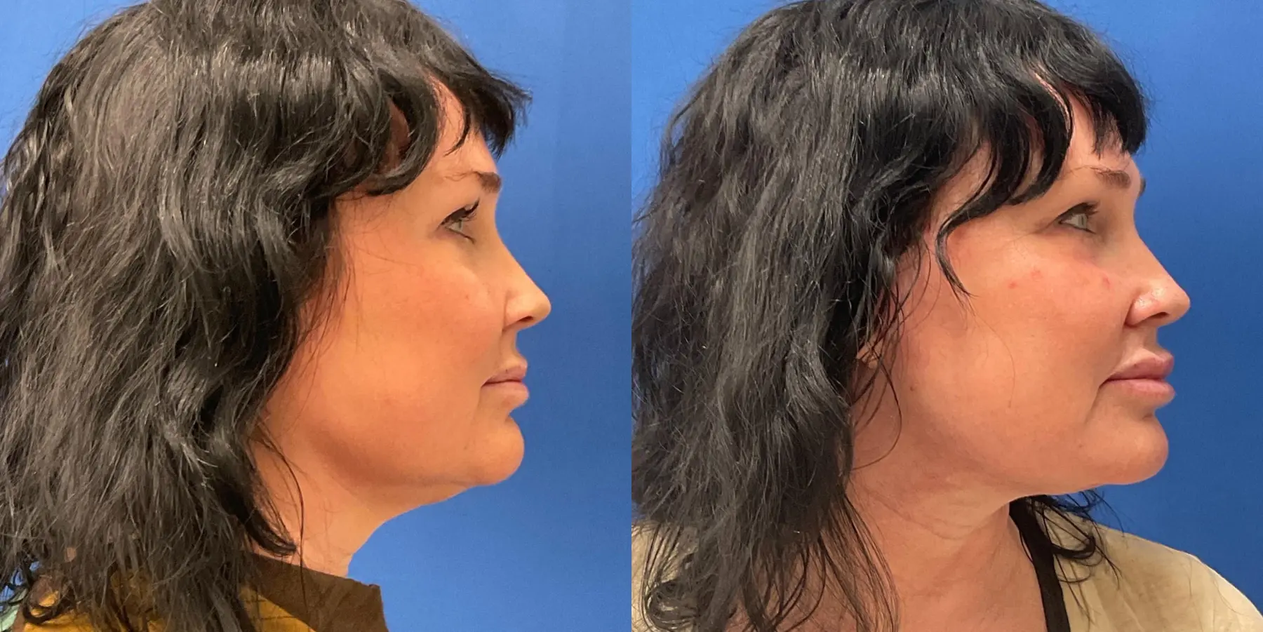 Facelift: Patient 5 - Before and After 1